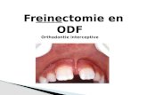 Diastèmes, freins, freinectomie,  en orthodontie