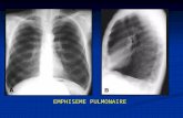 EMPHISEME PULMONAIRE. Radiologie– pneumonie au stafiloccoc - distribution bilaterale - abces a paroi mince - pleuresie bilaterale - poche pleurale gauche.