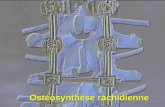 Ostéosynthèse rachidienne. Homme de 55 ans, chute dune échelle, fracture de L1 Radiographie standardReconstruction au scanner.