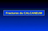 Fractures du CALCANEUM. Calcaneum vue interne Articulation sous- astragalienne Grosse tubérosité Sustentaculum.