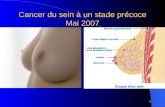 1 Cancer du sein à un stade précoce Mai 2007. 2 Dépistage en Seine et Marne Docteur Eliane BERNARD (ADC 77)