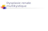Dysplasie renale multikystique. L'hypothèse physiopathologique actuellement retenue forme très sévère de sténose infundibulo-pyélique ou urétérale.