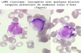 LAM3 classique: leucopénie avec quelques blastes sanguins présentant de nombreux corps dAuer (fagots)