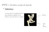 Définition: consiste dans le remplacement de deux éléments malades de la hanche ( tête du fémur et cotyle) PTH = Prothèse totale de hanche.