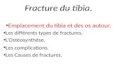 Fracture du tibia. Emplacement du tibia et des os autour. Les différents types de fractures. LOstéosynthèse. Les complications. Les Causes de fractures.