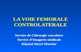LA VOIE FEMORALE CONTROLATERALE Service de Chirurgie vasculaire Service dImagerie médicale Hôpital Henri Mondor.