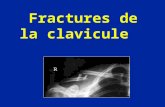 Fractures de la clavicule. •Fréquentes chez l’enfant (30% des fractures) •Chutes sur la main ++ •Chocs directs sur l’épaule.