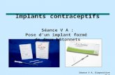 Séance V A, Diapositive n o 1 Implants contraceptifs Séance V A : Pose d’un implant formé de deux bâtonnets.