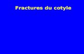 04  fractures du cotyle (1)