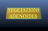 Végétations adénoïdes