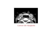 Cancer de l'épiglotte