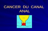 CANCER  DU  CANAL  ANAL