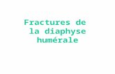 Fractures de  la diaphyse humérale