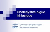 Cholecystite aigue lithiasique