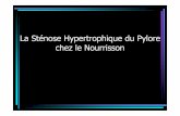 La Sténose Hypertrophique du Pylore chez le Nourrisson duoden… · Tableau Clinique I Dominé par les vomissements •Début après 3-4 semaines , garçon 80 % •Intervalle libre