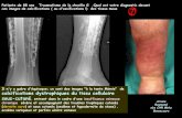 Patiente de 88 ans Traumatisme de la cheville G .Quel …onclepaul.net/wp-content/uploads/2011/07/ivcFILEminimizer1.pdf · un syndrome des loges. • RX et scanner: lésion calcifiée