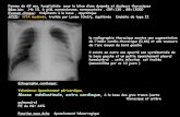 Femme de 69 ans, hospitalisée pour le bilan d’une …onclepaul.net/wp-content/uploads/2011/07/thorax-pgcFILEminimizer1.pdf · ATCD: HTA modérée, traitée par Loxen 10x2/j, équilibrée
