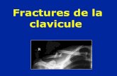 Fractures de la clavicule - mdem.org Fractures distales : hauban (broches et fil en 8) Traitement chirurgical . Fractures ouvertes Traitement possible par un mini fixateur externe