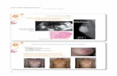 DOSSIER THÉMATIQUE Cas cliniques en images - … · du sein gauche Biopsie : CCI grade II, RE+, RP+, Her - Patiente de 57 ans T2NO QSE gauche Plastie mammaire pour cancer par ...