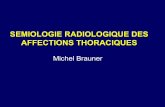 SEMIOLOGIE RADIOLOGIQUE DES AFFECTIONS andre.ar.free.fr/  · PDF fileSyndrome de comblement alvéolaire (ECN I-7-86) • Signes radiographiques liés au remplacement de l’air alvéolaire