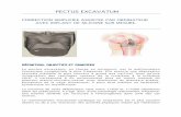 Pectus Excavatum Fiche d'information FR avr. 2016 · DÉFINITION, OBJECTIFS ET PRINCIPES Le pectus excavatum, ou thorax en entonnoir, est la malformation ... de la peau avec l’électrode