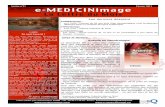 Lettre n°51 Février 2013 e-MEDICINimage · Un score pronostique pour la Myéloﬁbrose Primitive La Myéloﬁbrose Primitive (MFP) est l'un des 4 syndromes myéloprolifératifs