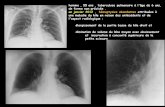 homme , 55 ans , tuberculose pulmonaire à l'âge de 6 …onclepaul.net/wp-content/uploads/2011/07/Behcet-sd-de-Hughes... · devant ces seules images de la VCI , en l'absence de cause