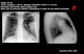 Homme 44 ans ATCD: tabagisme 1-15 PA, séminome ...onclepaul.net/wp-content/uploads/2011/07/adpn1.pdf · être discutée la CAT : biopsie transpariétale ou , préférentiellement