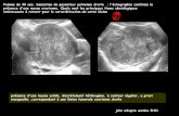 Femme de 40 ans. Sensation de pesanteur pelvienne …onclepaul.fr/wp-content/uploads/2011/07/fibromes-ovariens-def-2014.pdf · d'augmenter le risque de cancer du sein . Tumeur de
