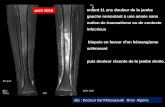 avril 2016 enfant 11 ans douleur de la jambe gauche …onclepaul.net/wp-content/uploads/2011/07/OCMR1.pdf · forme pédiatrique du syndrome SAPHO (synovite, acné, pustulose palmo-plantaire,