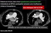 Antécédents de BPCO, cardiopathie valvulaire avec ...onclepaul.fr/wp-content/uploads/2011/07/HTP-et-HTAP.pdf · Patiente de 76 ans, bilan d’une hypertension pulmonaire HTP Antécédents