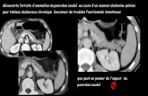 découverte fortuite d'anomalies du pancréas caudal au ...onclepaul.fr/wp-content/uploads/2011/07/bifand1.pdf · le pancréas caudal est le siège d'une variante anatomique rare