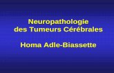 Neuropathologie des tumeurs du SNCcoursl3bichat2012-2013.weebly.com/uploads/9/6/0/7/9607940/t... · « Hémorragies de Duret » Engagement des amygdales cérébelleuses par le trou