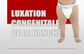 LUXATION CONGENITALE DE LA HANCHEuniv.ency-education.com/uploads/1/3/1/0/13102001/... · Fréquence : variable d ... Facteurs génétiques et endogénes Sexe féminin ATCD familiaux