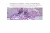 Dipòsit Digital de Documents de la UAB - 6-35 …6-37 Implante de alúmina teñido con hematoxilina-eosina. (A) Zonas blancas artefactuales por fragmentación de la pieza al corte