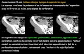 Jeune femme 25 ans, tableau clinique typique d'appendicite ...onclepaul.fr/wp-content/uploads/2011/07/appendicolithe-perdu1.pdf · d'appendicite aiguë , on sait maintenant, grâce