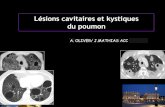 Lésions cavitaires et kystiques du poumononclepaul.fr/wp-content/uploads/2011/07/lésions-kystiques-et... · • Les lésions ont souvent des caractéristiques bénignes (parois