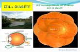 LA RETINOPATHIE DIABETIQUE - Freesofomec11.free.fr › Diapos › DIABETE › oeil_patient_diabetique_dr_jm... · vasculaires du fond d’œil,pour « les classer et pour évaluer