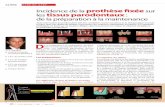 CLINIC Incidence de la prothèse fixée tissus parodontaux · 28 < LE FIL DENTAIRE < N°61 < Mars 2011 CLINIC STEP BY STEP Incidence de la prothèse fixée sur les tissus parodontaux: