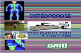 OSTÉOPOROSE - GRIO · 2017-01-17 · L'ostéoporose est une maladie qui a été longtemps méconnue et dont les conséquences ont été sous estimées. On sait maintenant qu'il s'agit