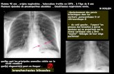 Homme 42 ans , origine maghrebine , tuberculose traitée en 1976 , …onclepaul.net/wp-content/uploads/2011/07/poumons-dFILE... · 2012. 12. 31. · quelles sont les principales anomalies