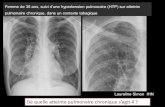 De quelle atteinte pulmonaire chronique s’agit-ilonclepaul.net/wp-content/uploads/2011/07/lanhis.pdf · 1953 : Lichtenstein regroupe tous les syndromes connus sous le terme d’Histiocytose