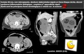Femme 50 ans, douleurs abdominales aigues en fosse iliaque ...onclepaul.fr/wp-content/uploads/2011/07/torsion-ovarienne...Tératome kystique mature : 20 % % des tumeurs ovariennes