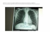 AICHA M ..7ans m’a consultée le 8/05/12 pour infections … · 2019. 9. 6. · Emphysème sous-cutané (cervical ... Fillette de 7ans ayant été victime d’un traumatisme thoracique