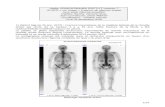 Atelier SFMN/ACORAMEN SPECT/CT osseuse 7 Frédéric ... NANTES...est adressé pour une récidive biochimique occulte d’un cancer de la prostate Gleason 8 (4+4) traité par radiothérapie