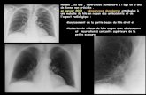 homme , 55 ans , tuberculose pulmonaire à l'âge de 6 ans, de ...onclepaul.fr/wp-content/uploads/2011/07/Behcet-sd-de...maladie de Behcet , elle se caractérise par l'association