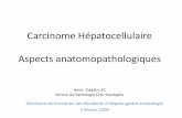 Carcinome Hépatocellulaire Aspects anatomopathologiques