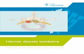 Hernie discale lombaire - UZ Leuven