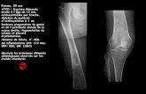 ATCD : fracture fémorale âge de 12 ans, ostéosynthésée par ...