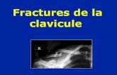 Fractures de la clavicule - mdem. Fractures distales : hauban (broches et fil en 8) Traitement chirurgical